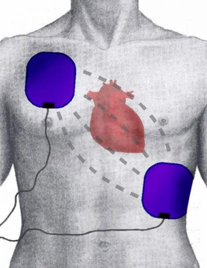 Defibrillation