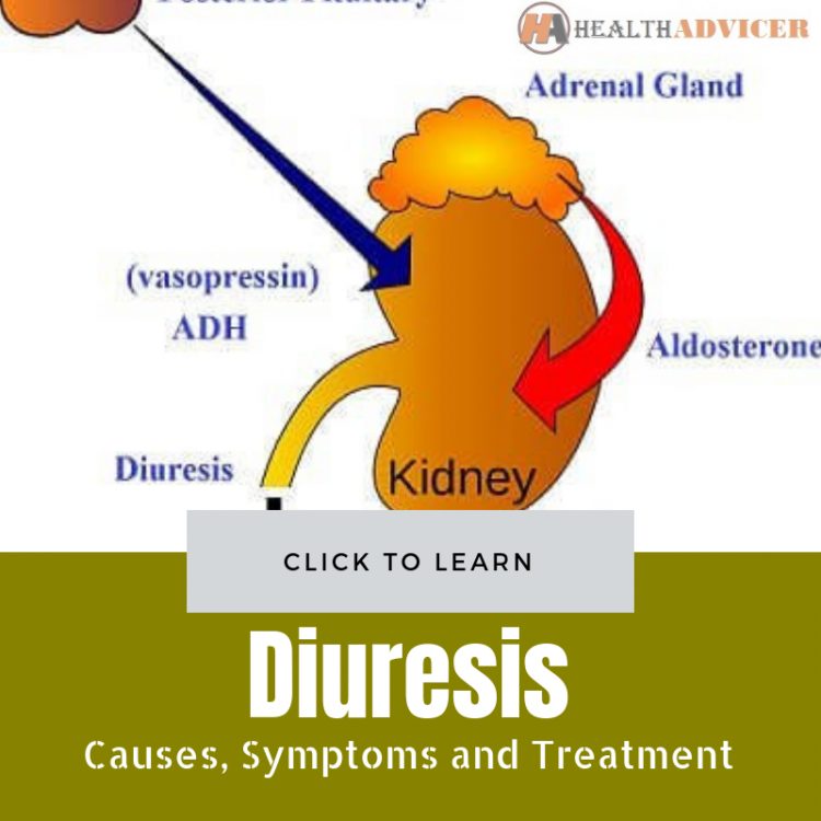 Diuresis Causes Treatment