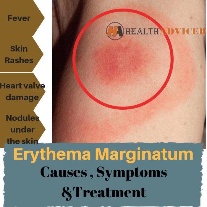 Erythema Marginatum