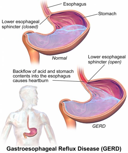 Acid Reflux