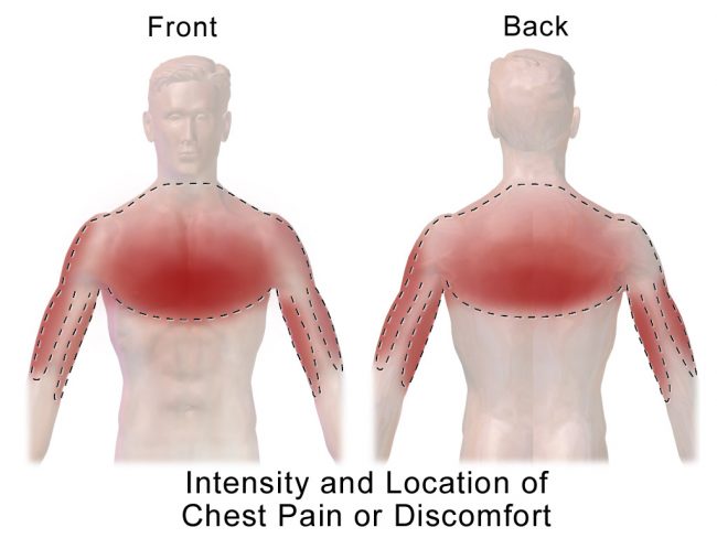 Typical Chest Pain Symptoms