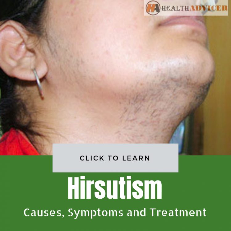 Hirsutism Causes Treatment