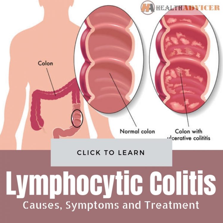 Lymphocytic Colitis