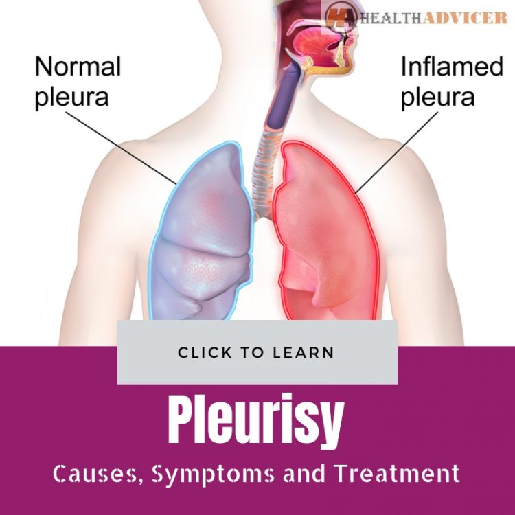 Pleurisy Causes Treatment