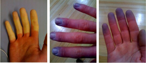 Raynaud’s phenomenon