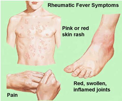 Rheumatic Fever