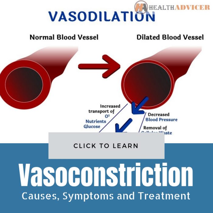 Vasoconstriction Causes Treatment