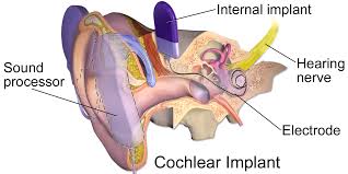 Cochlear Implants