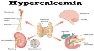 Hypercalcemia