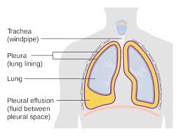 Pleural Effusion