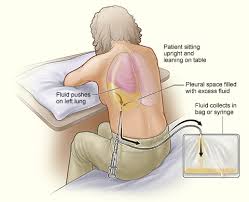 Thoracentesis