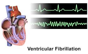 Ventricular fibrillation