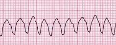 Ventricular Tachycardia