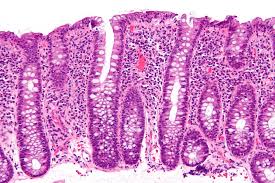 What Is Lymphocytic Colitis