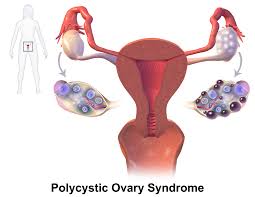 Polycystic Ovary Syndrome