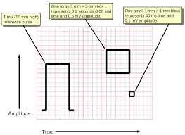 Electrocardiogram