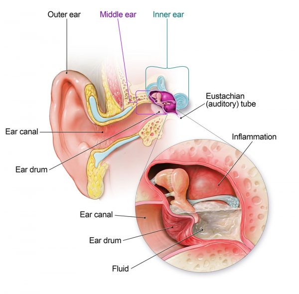 Ear Infection