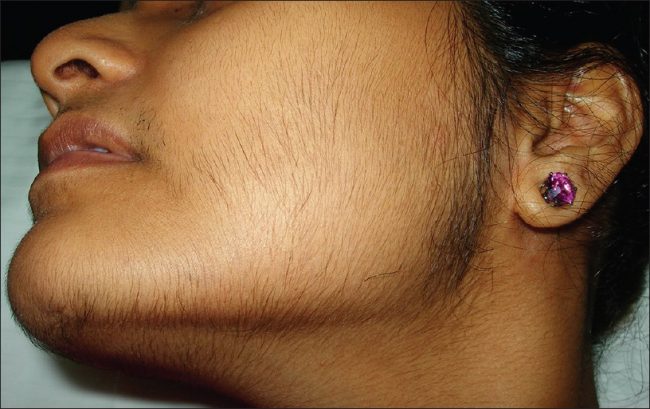 Hirsutism