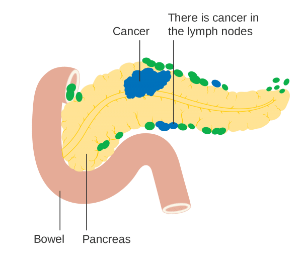 Pancreatic Cancer