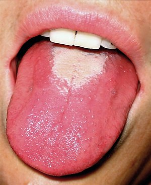 Chronic Glossitis