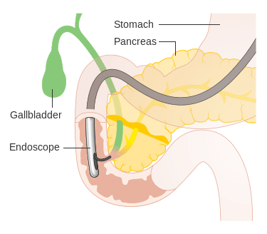 ERCP