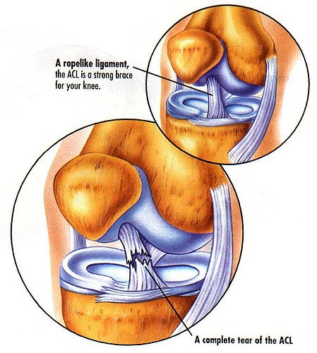 MCL Tear Or Injury