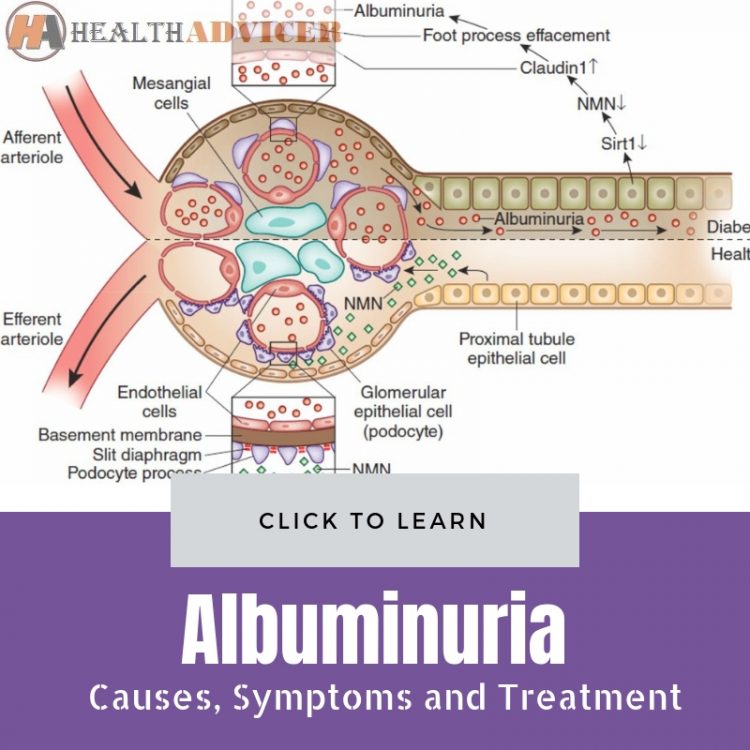 Albuminuria Causes Treatment