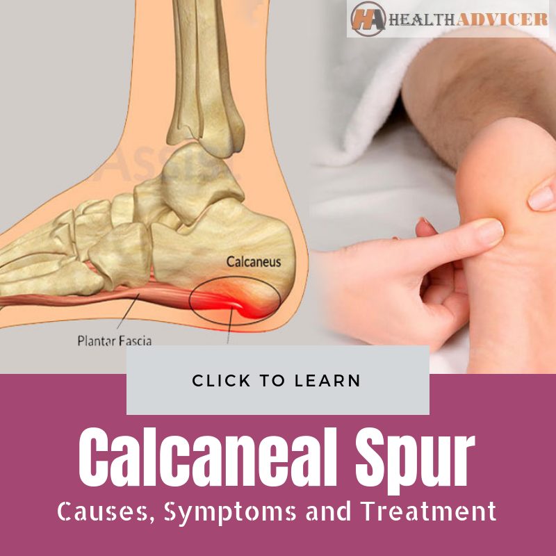 Calcaneal Spur Causes Treatment
