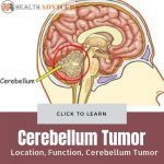Cerebellum Tumor