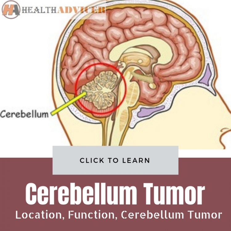 Cerebellum Tumor