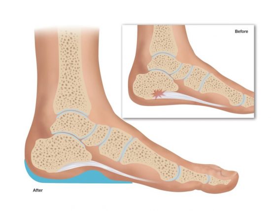 Functional Orthotic Device