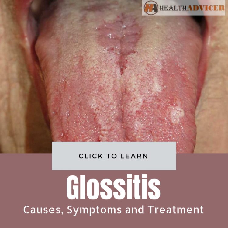 Glossitis Causes Treatment