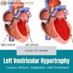 Left Ventricular Hypertrophy