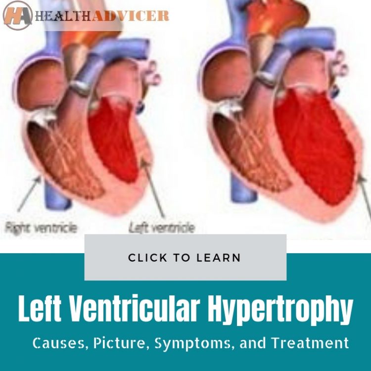 Left Ventricular Hypertrophy: Causes, Picture, Symptoms, And Treatment
