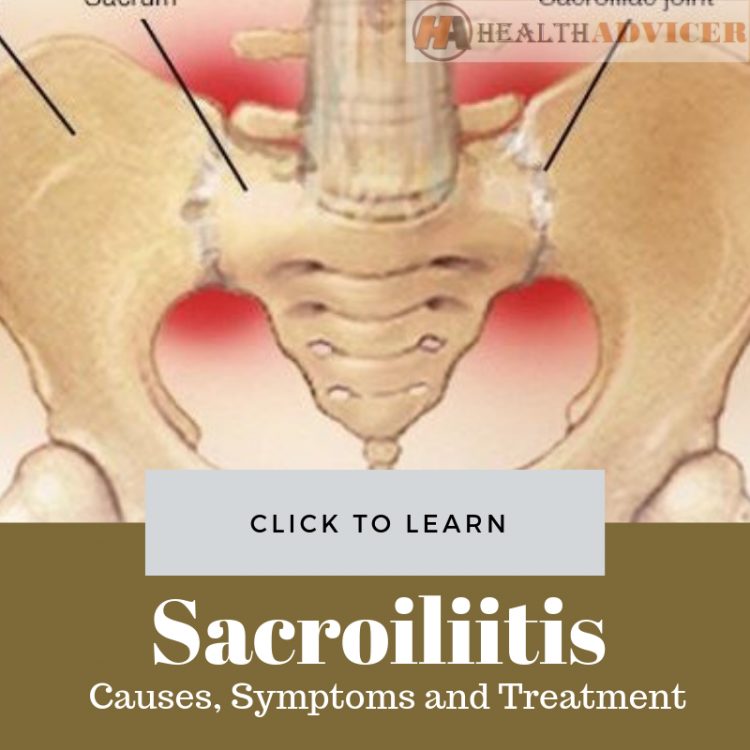 Sacroiliitis Causes Treatment