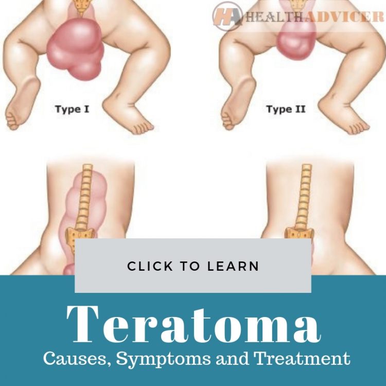 Teratoma Pictures