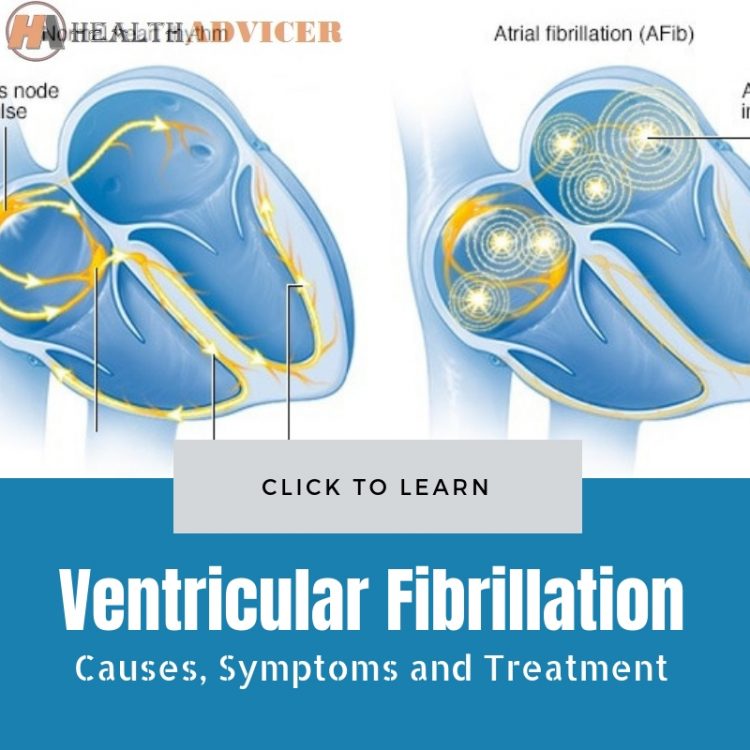 Ventricular Fibrillation: Causes, Picture, Symptoms, And Treatment.