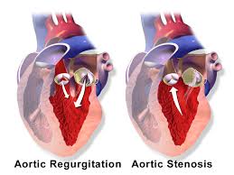 Aortic Valve Stenosis