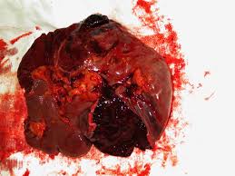 Ruptured (Lacerated) Spleen