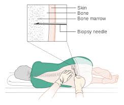 Bone Marrow Biopsy