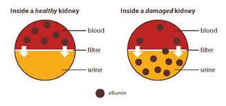 Albuminuria