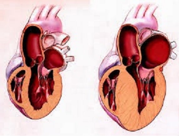 Left ventricular hypertrophy