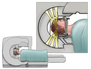 Stereotactic Radiosurgery