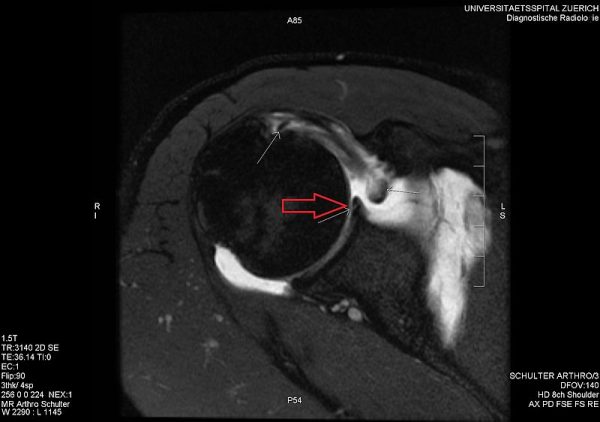 One Of The Common Shoulder Injuries: SLAP Tear