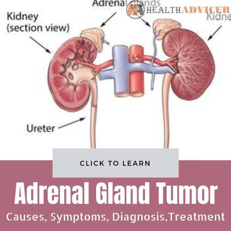 Adrenal Gland Tumor