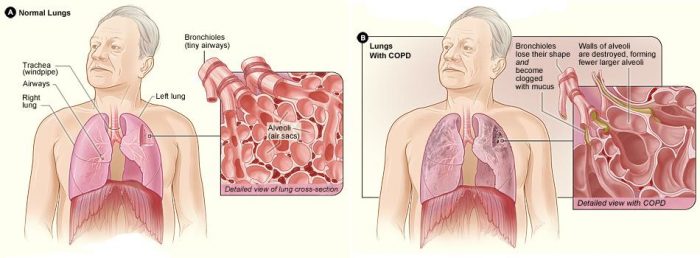 COPD (Chronic Obstructive Pulmonary Disease)