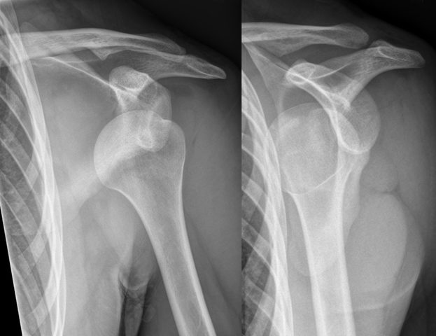 Shoulder Instability/Dislocated Shoulder