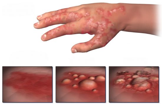 Eczema