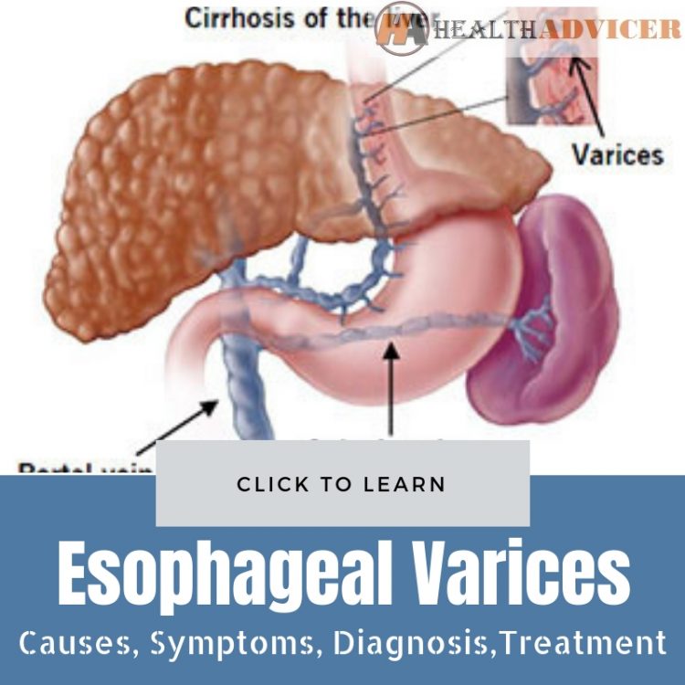 Esophageal Varices