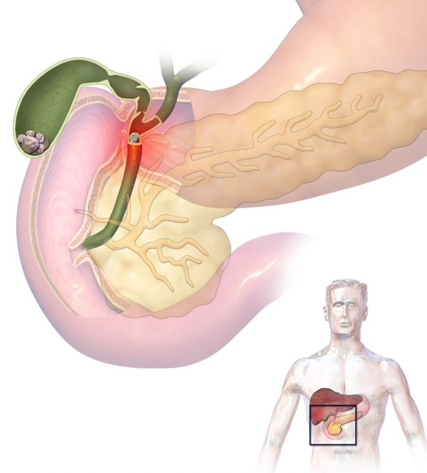 gall bladder infection